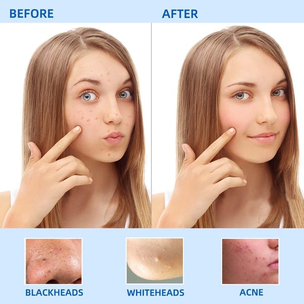 Blackhead Remover Tool Kit 5 Pack